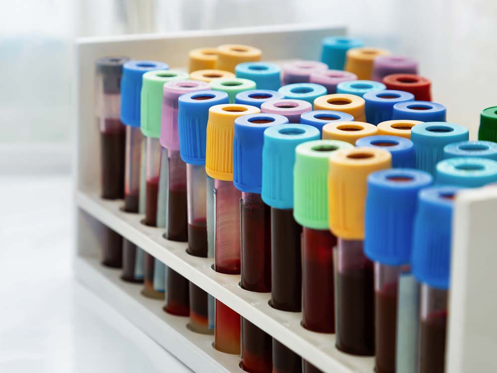 ChatGPT: Reagenzgläser mit Blutproben in einem Laborständer mit verschiedenfarbigen Deckeln